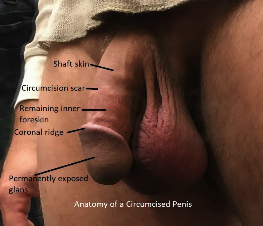 Anatomy of a Circumcised Penis_900x1047