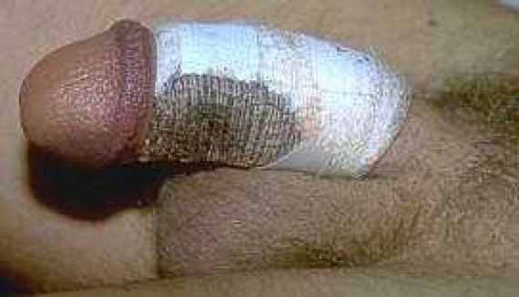 Cut_post OP