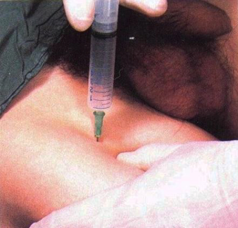Local Anesthesia (Kopie)